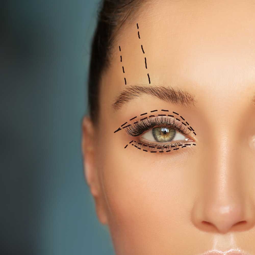 Blepharoplasty (Eyelid Surgery) consultation at LHCSC London, London