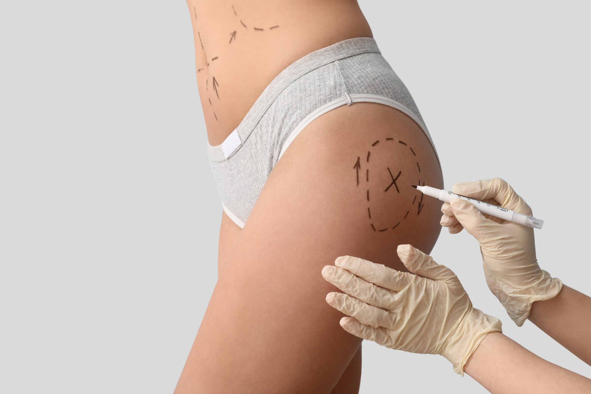 Thigh Liposuction results at LHCSC London, London