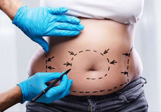 Abdomen & Back Liposuction consultation at LHCSC London, London