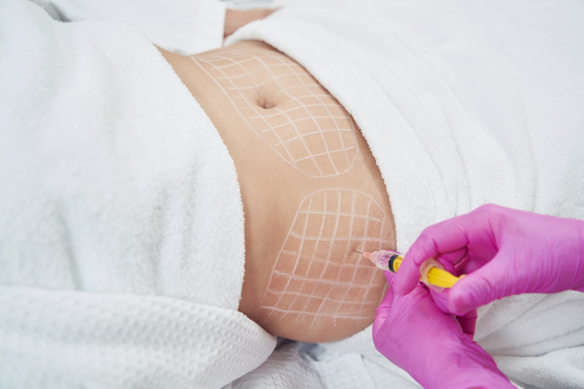 Liposuction body contouring at LHCSC London