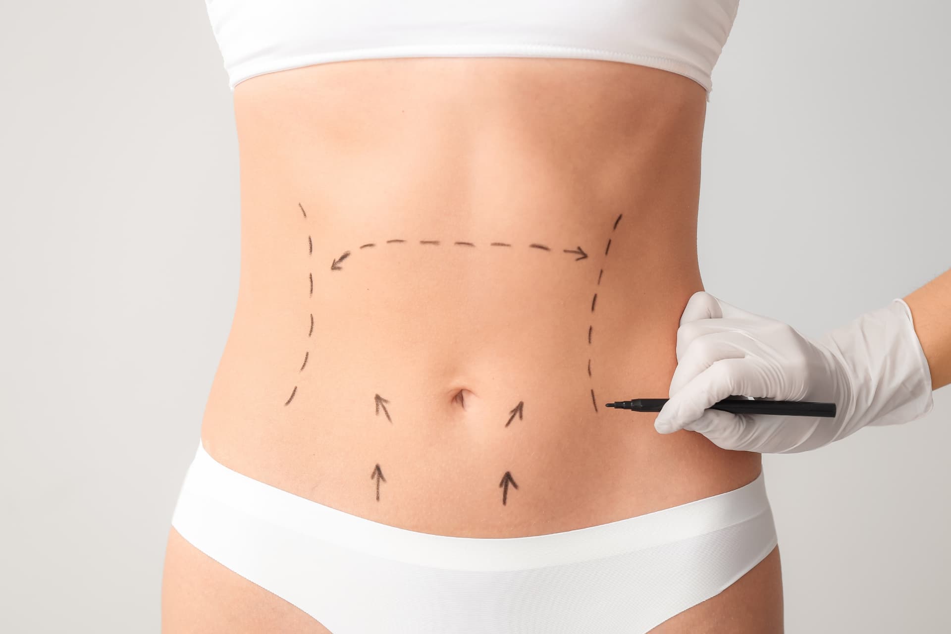 Tummy tuck surgical planning at LHCSC London