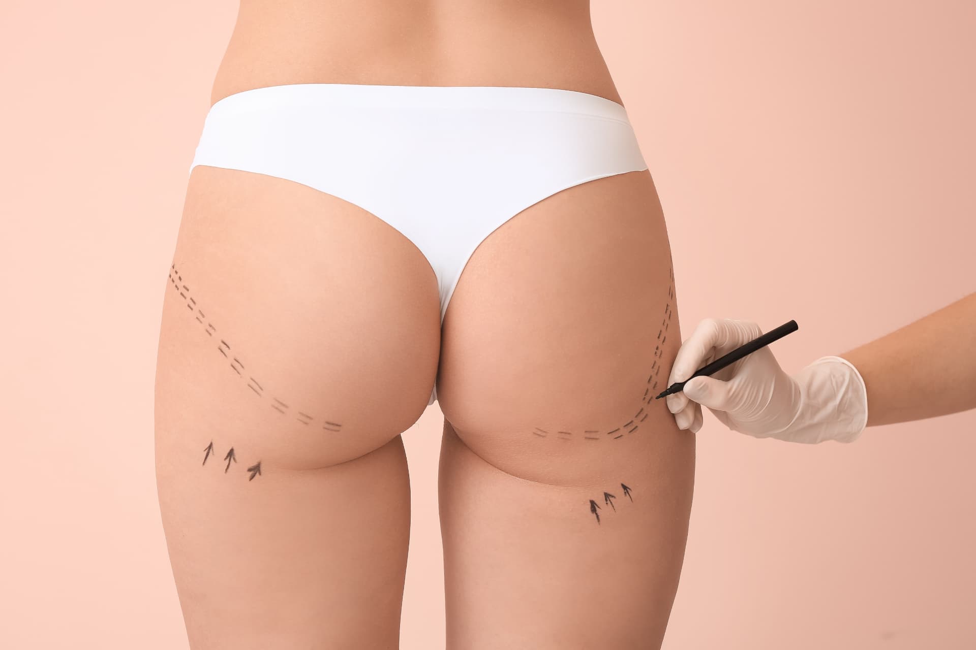 Thigh Liposuction consultation at LHCSC London, London