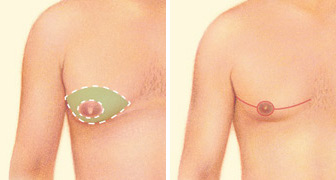 Male Breast Liposuction (Gynaecomastia) at LHCSC London, London