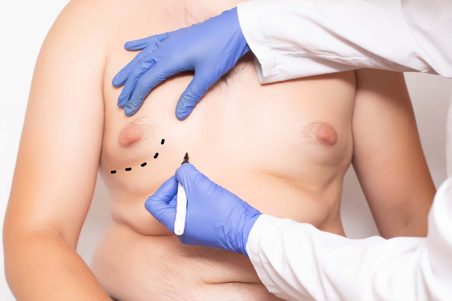 Male Breast Liposuction (Gynaecomastia) consultation at LHCSC London, London