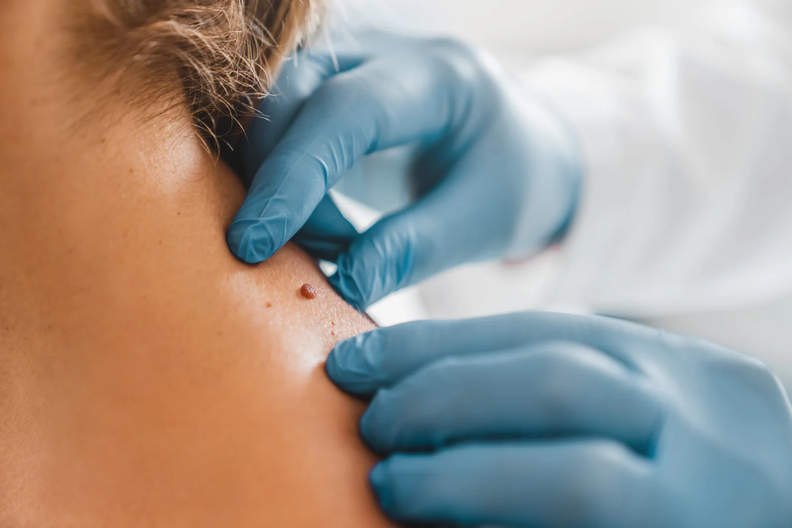 Mole Removal consultation at LHCSC London, London