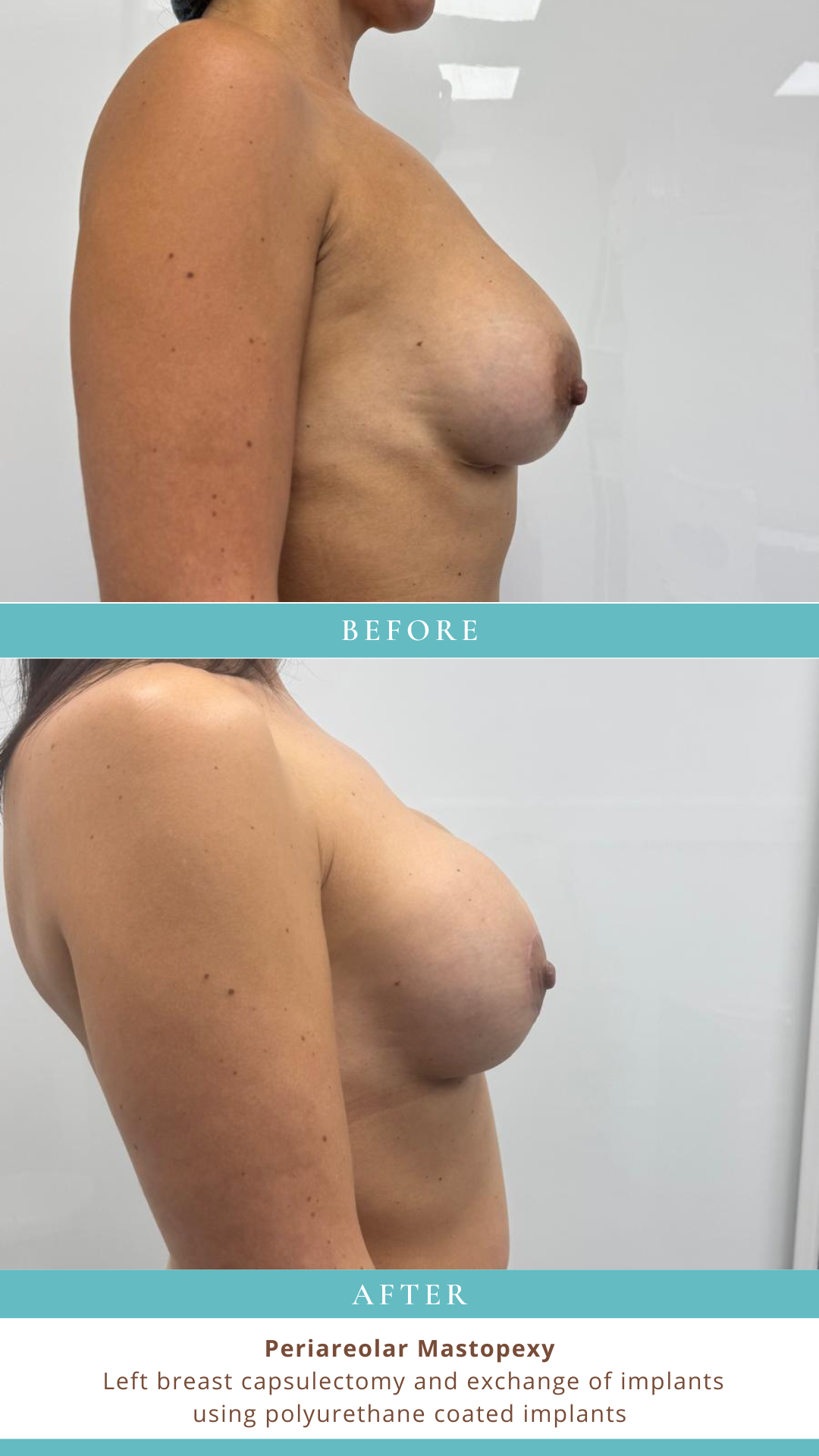 Breast before and after — Periareolar Mastopexy at LHCSC London