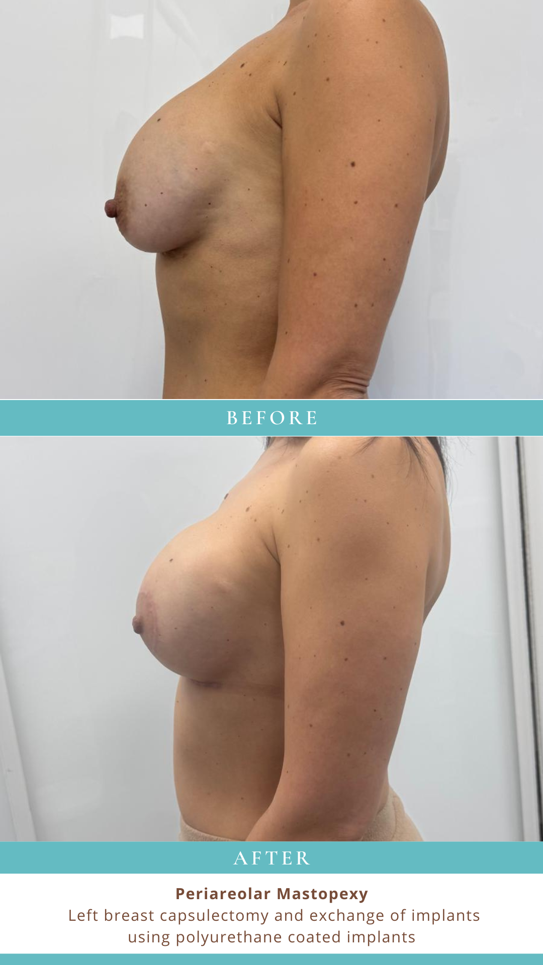 Breast before and after — Periareolar Mastopexy at LHCSC London