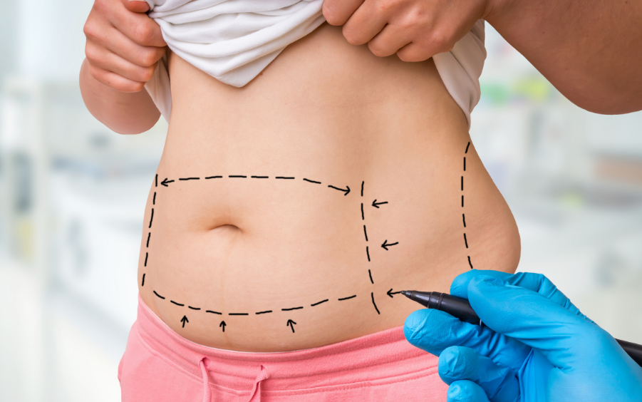 Liposuction surgical planning at LHCSC London