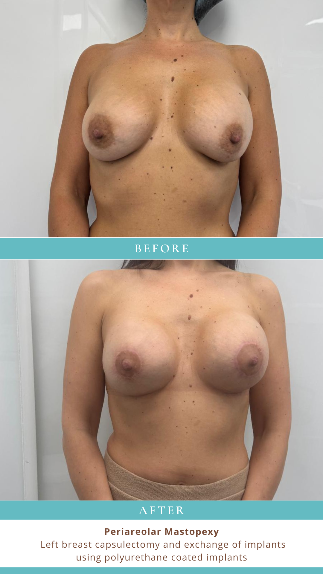 Breast before and after — Periareolar Mastopexy at LHCSC London