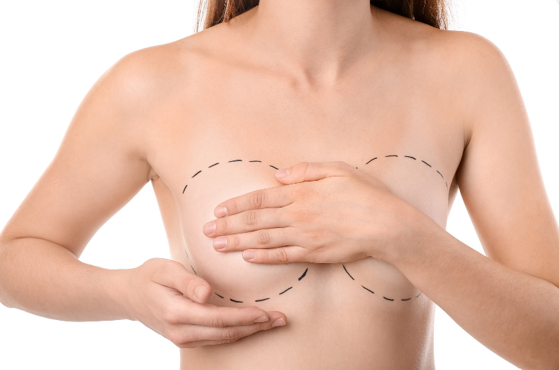 Breast Implant Removal results at LHCSC London, London