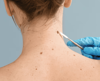 Mole Removal results at LHCSC London, London