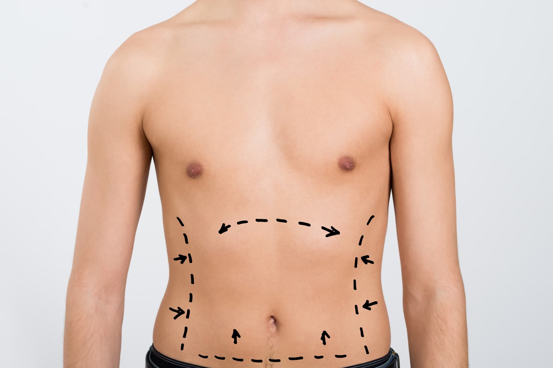Abdomen & Back Liposuction results at LHCSC London, London