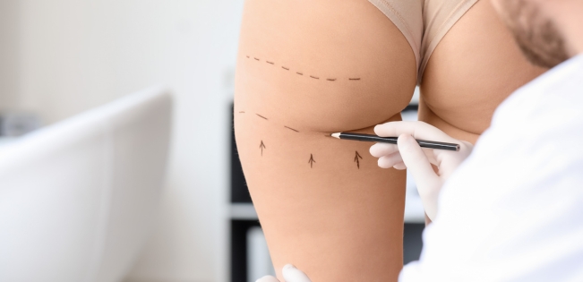 Hips Liposuction at LHCSC London, London