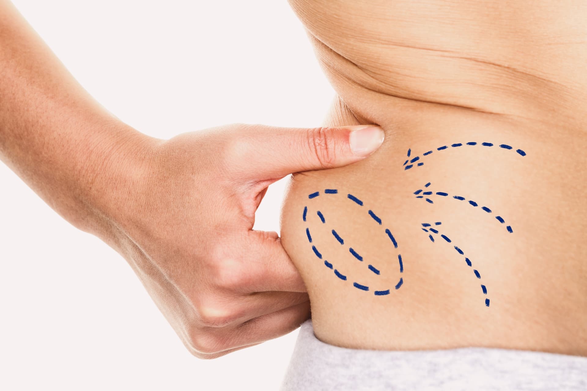 Liposuction at LHCSC London