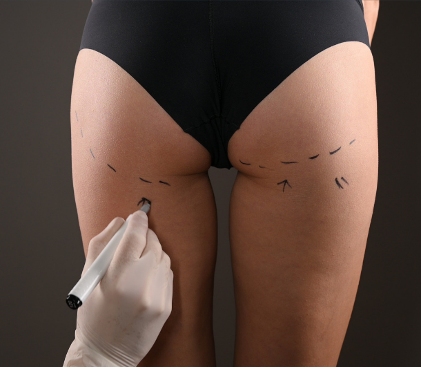 Hips Liposuction results at LHCSC London, London