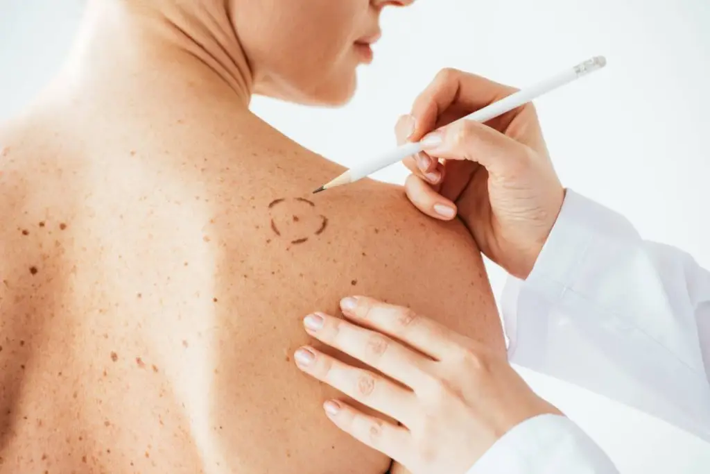 Mole Removal at LHCSC London, London