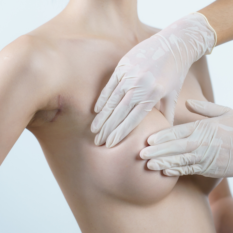 Breast surgery consultation at LHCSC London