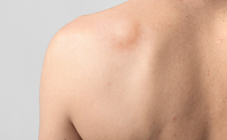Lipoma Removal at LHCSC London, London