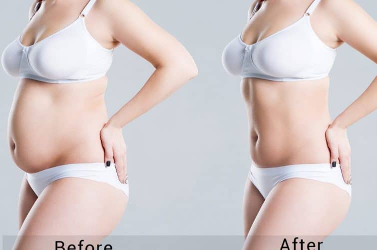 Liposuction (Before & After)