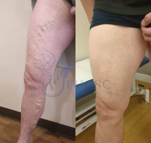 Vein Treatment (Before and After)