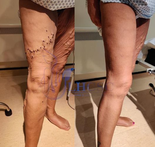 Vein Treatment (Before & After)