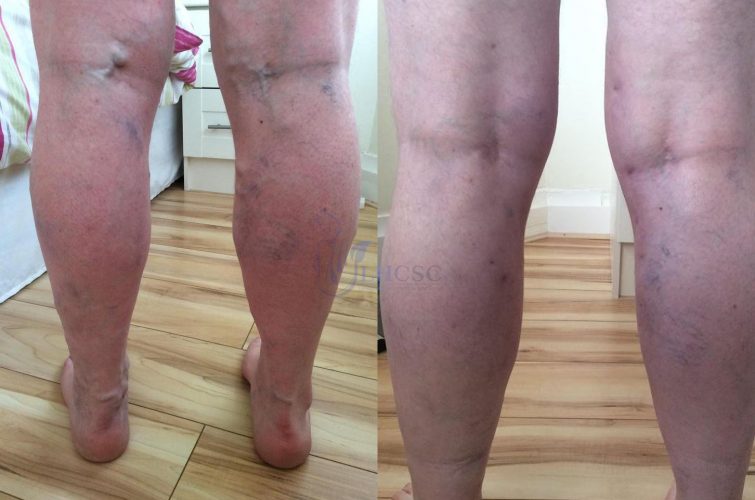 Vein Treatment (Before & After)