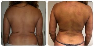Back Liposuction & Body Fat Removal Procedure - LHCSC