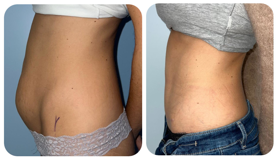 Back Liposuction & Body Fat Removal Procedure - LHCSC