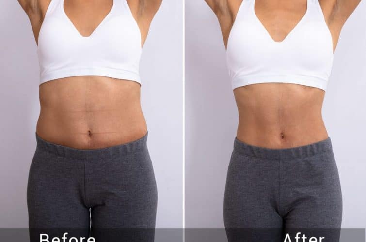 Front Liposuction (Before & After)