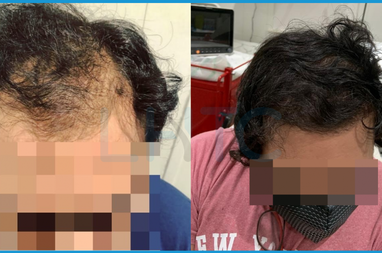 Hair Transplant (Before and After)
