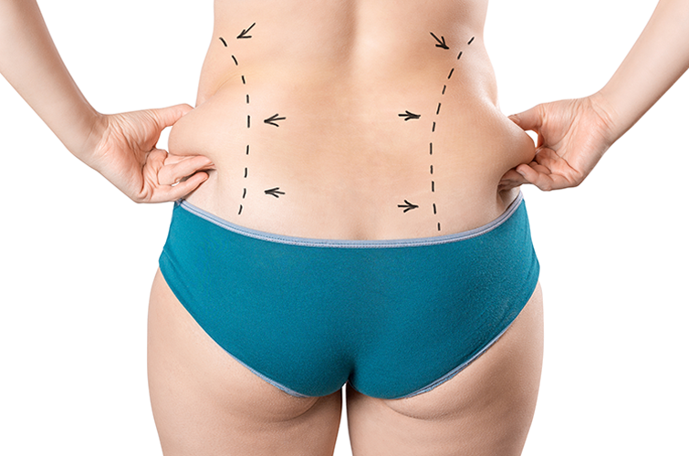 Liposuction (Back)