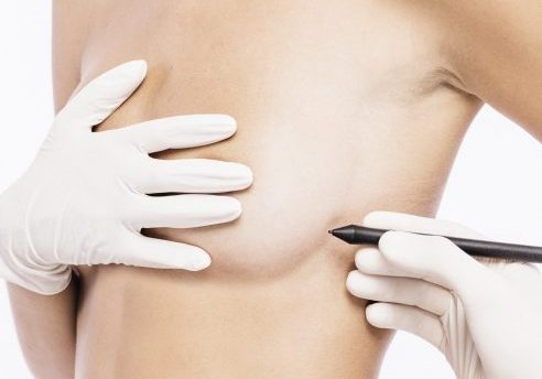 Breast Reduction Surgery for Women