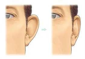 Prominent Ear Correction (Otoplasty)