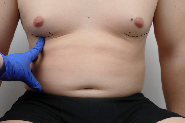 Male Breast Liposuction