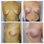 Breast augmentation (Before and After)