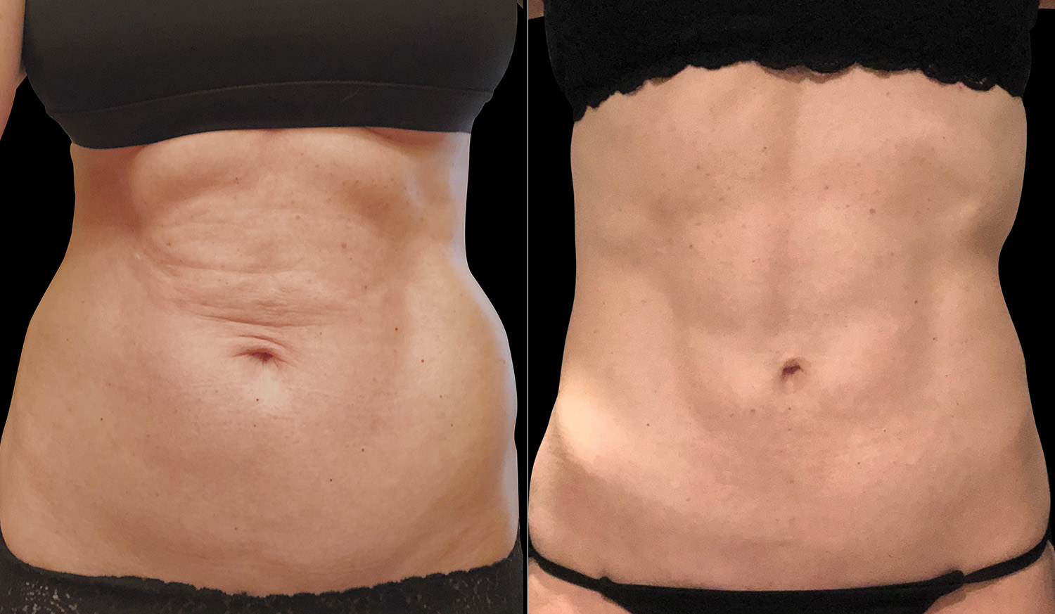 abdomen-before-after