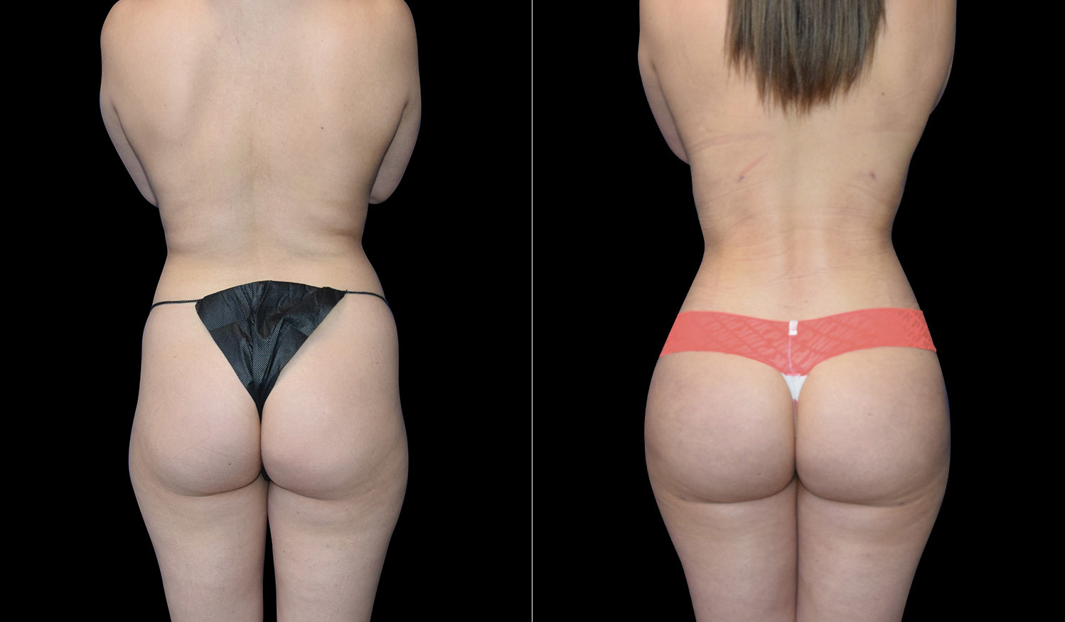 buttocks-sking-tightening-before-after