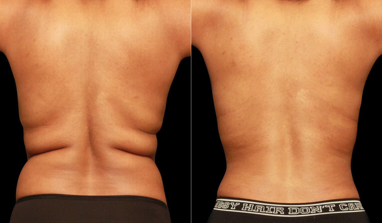 flanks-before-after