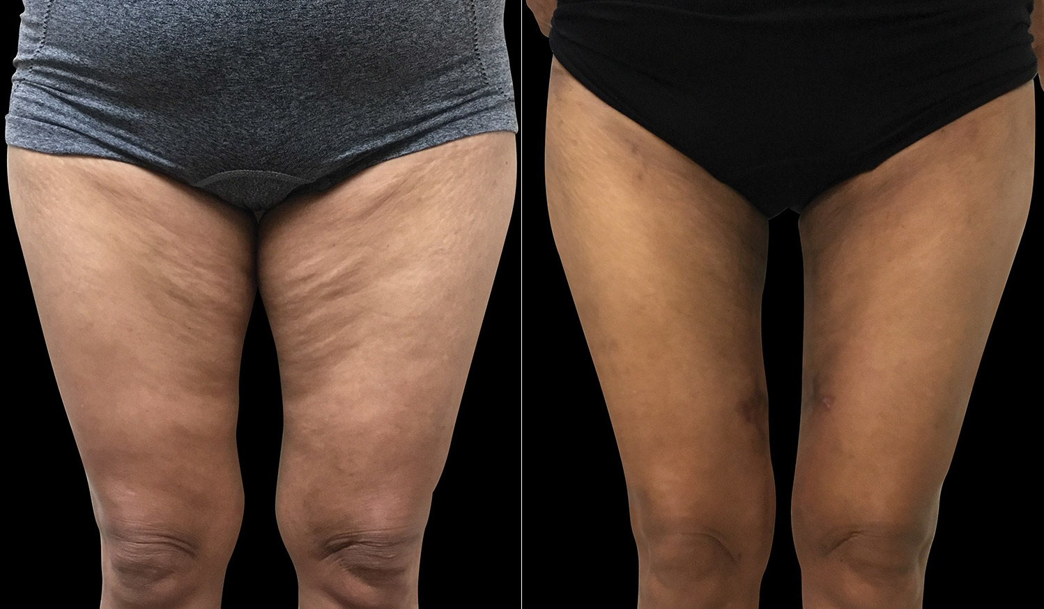 thighs-skin-tightening-before-after