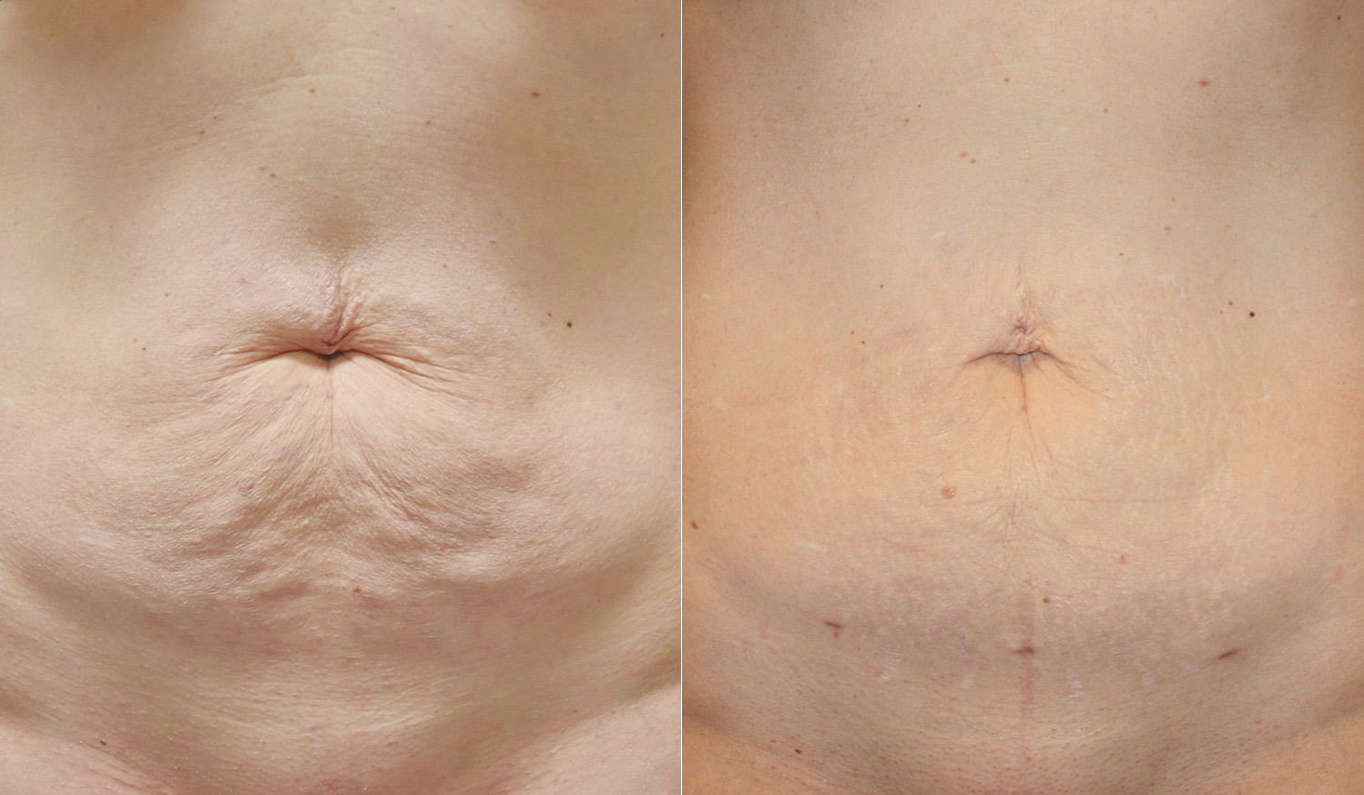 tummy-before-after