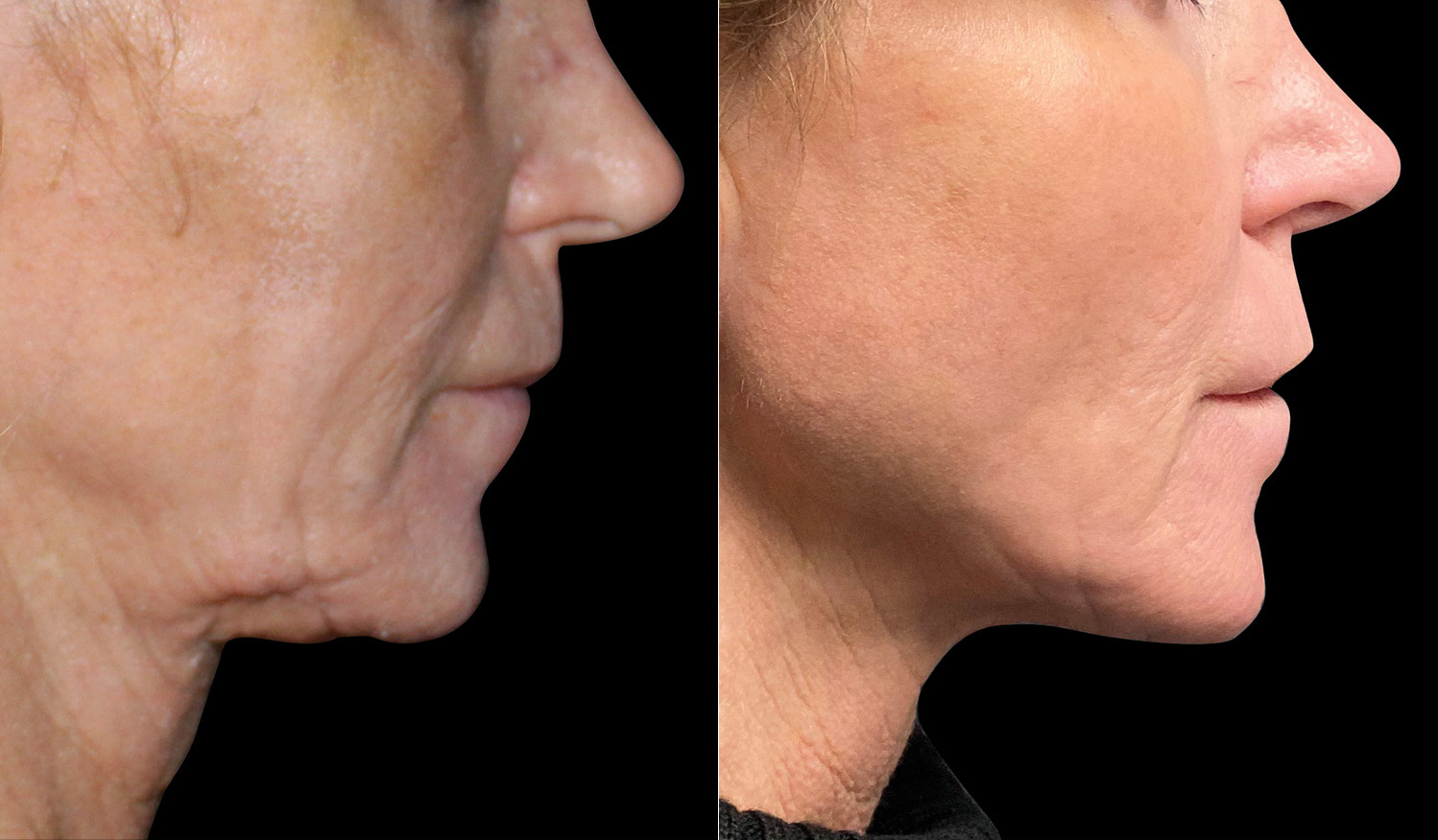 facial-skin-tightening-renuvion-lhcsc-london-2