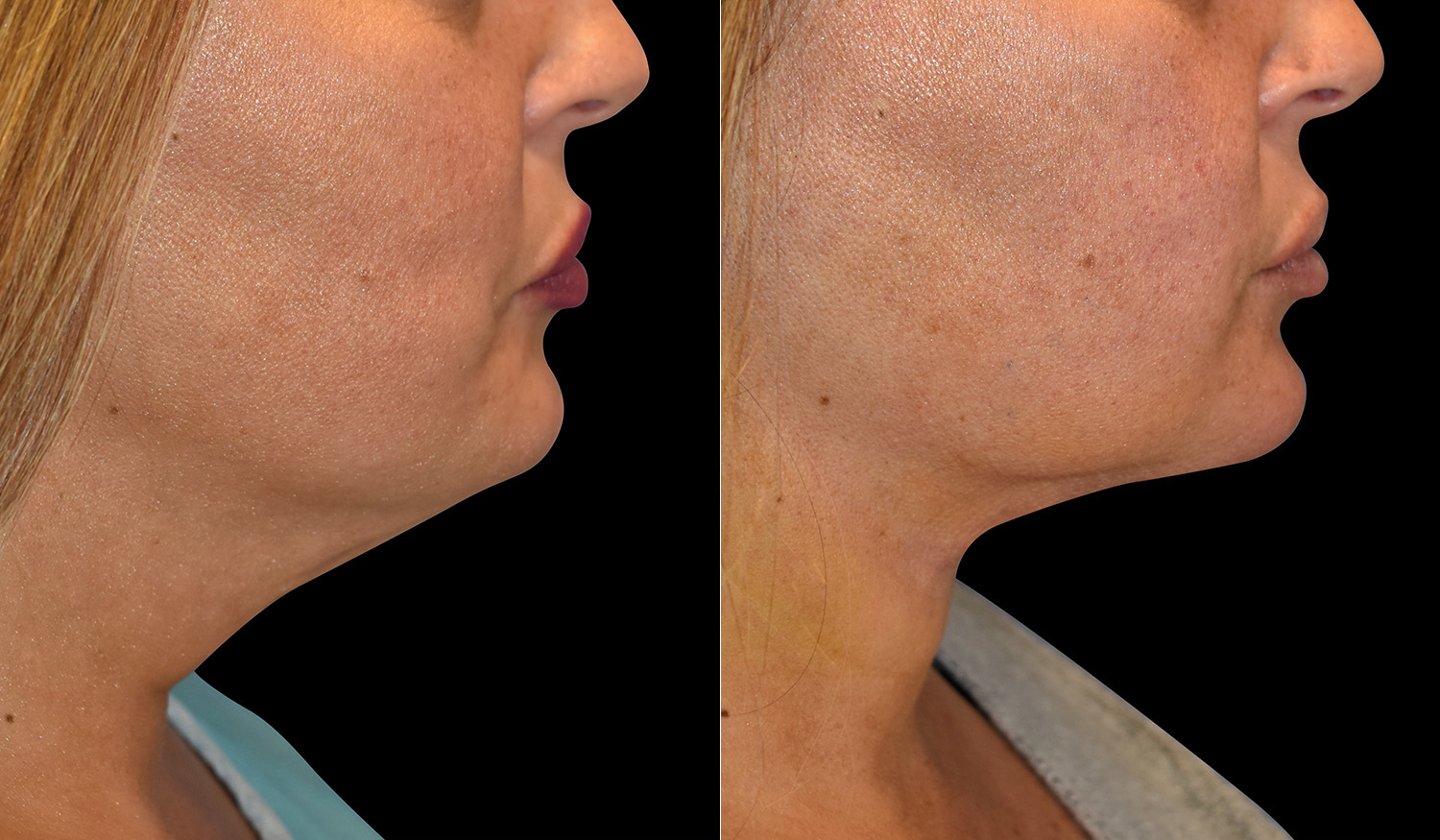 facial-skin-tightening-renuvion-lhcsc-london